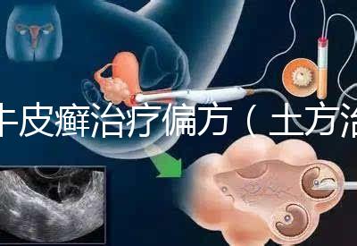 牛皮癬治療偏方(土方治牛皮癬)