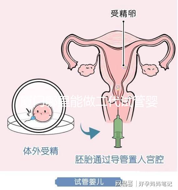 廈門哪里能做二代試管嬰兒，做一次成功率和費用多少？