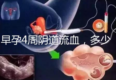 早孕4周陰道流血,多少天檢查血hcg或B超更穩妥?