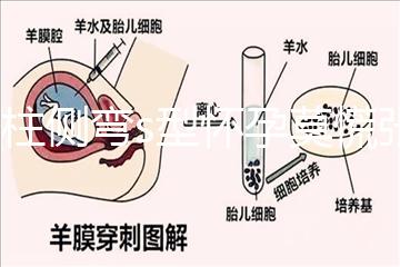 脊柱側(cè)彎s型懷孕莫慌張，能否順產(chǎn)還得看這4大要素
